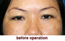 plastic-surgery-blepharoplasty